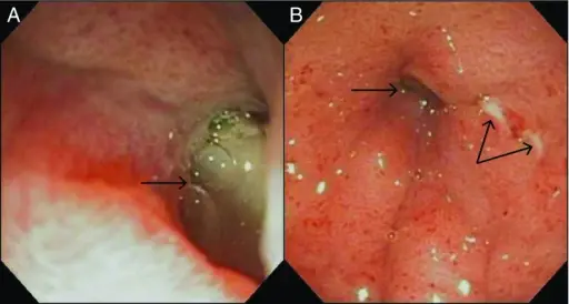 Pyloric Stenosis