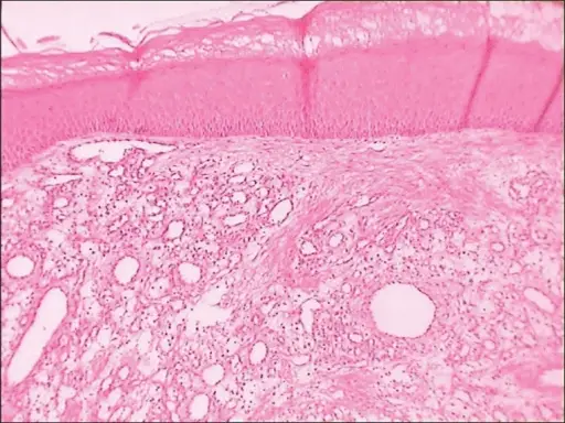 Pyogenic Granulomas