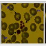 Qualitative Platelet Disorders