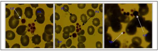 Qualitative Platelet Disorders