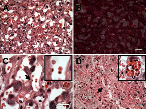 RED BLOOD CELL PATHOLOGY