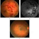 Radiation Vasculitis