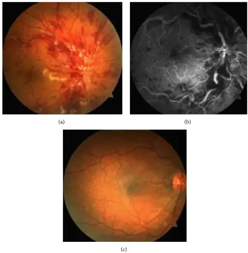 Radiation Vasculitis