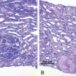 Rapidly Progressive Glomerulonephritis