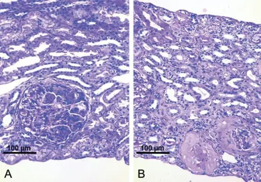 Rapidly Progressive Glomerulonephritis