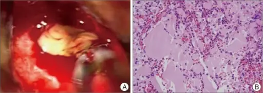 Rathke Cleft Cyst