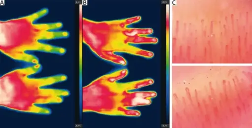 Raynaud Phenomenon