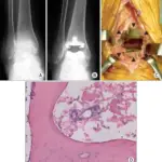 Reactive Arthritis