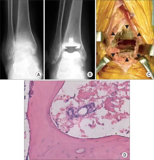 Reactive Arthritis