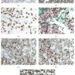 Reactive Proliferations of White Cells and Lymph Nodes