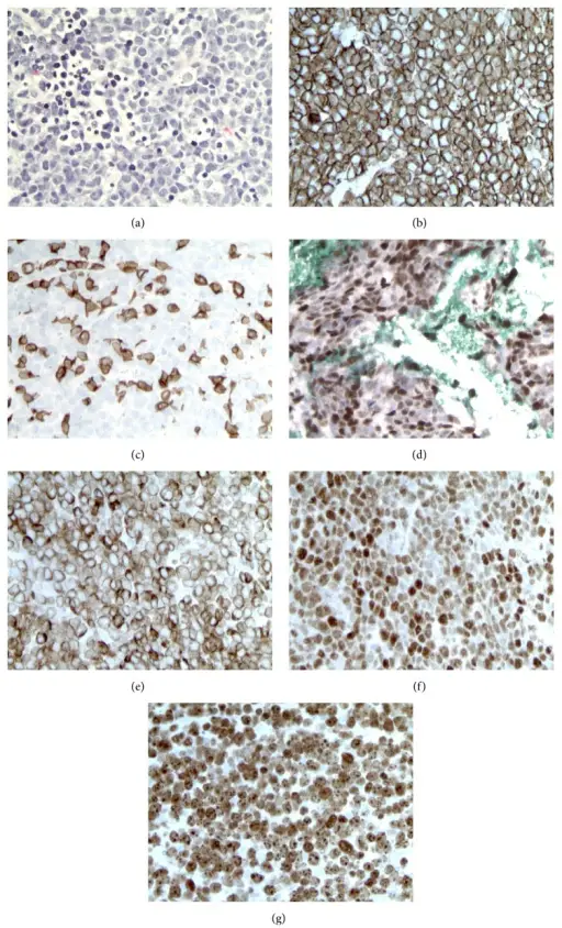 Reactive Proliferations of White Cells and Lymph Nodes