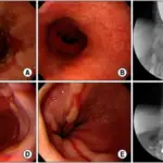 Reflux Esophagitis