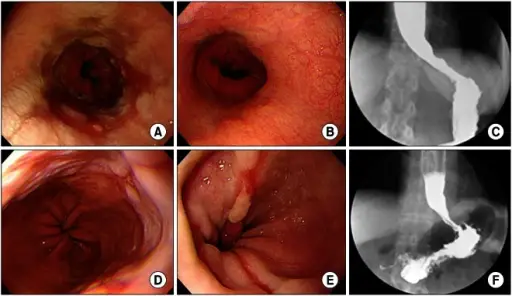 Reflux Esophagitis