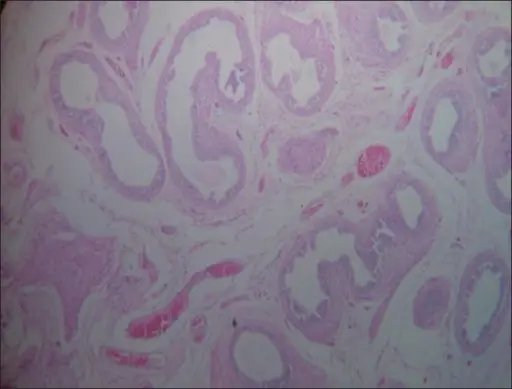 Regressive Changes of the Testis or Epididymis