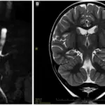 Renal Artery Stenosis