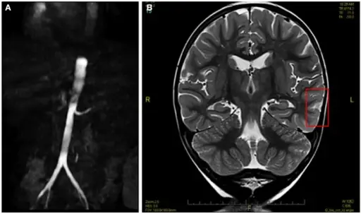 Renal Artery Stenosis