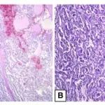 Renal Cell Carcinoma