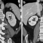 Renal Infarcts