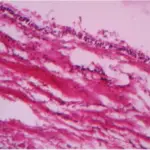 Residual Cyst