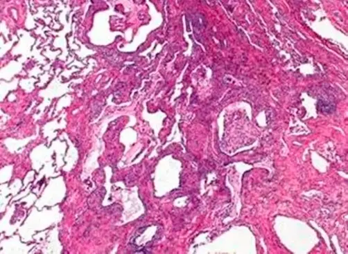 Respiratory Bronchiolitis-Associated Interstitial Lung Disease