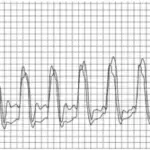 Restrictive Cardiomyopathy