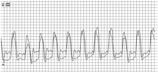 Restrictive Cardiomyopathy