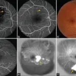 Retinal Artery Occlusion