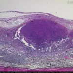 Retinal Lymphoma