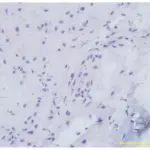 Retinal Neoplasms