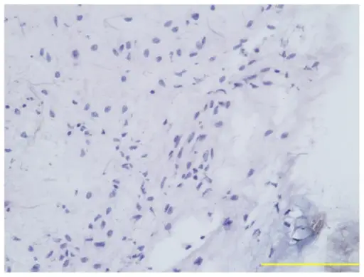 Retinal Neoplasms