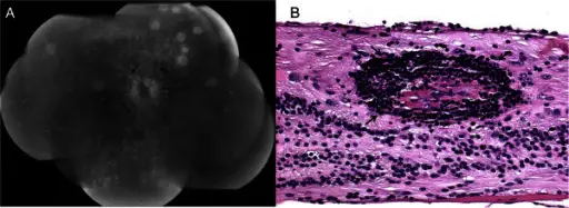 Retinal Vasculitis