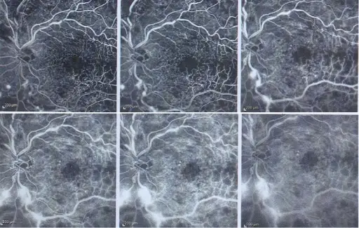 Retinal Vein Occlusion