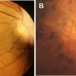 Retinitis Pigmentosa