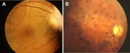 Retinitis Pigmentosa