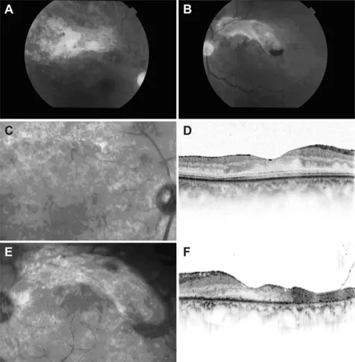 Retinitis