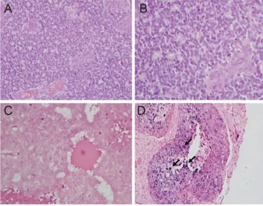 Retinoblastoma