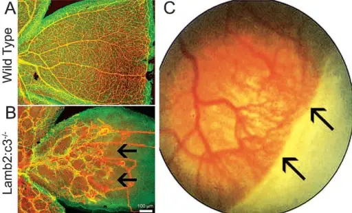 Retinopathy of Prematurity