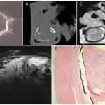 Retrolental Fibroplasia