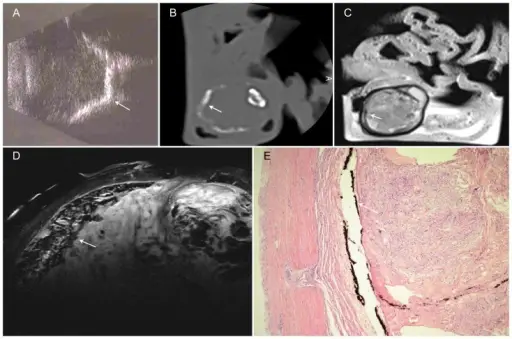 Retrolental Fibroplasia