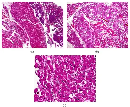 Rhabdomyoma