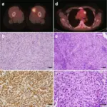 Rhabdomyosarcoma