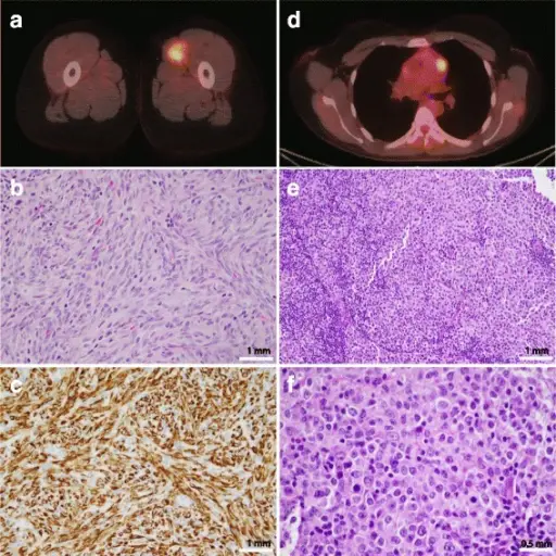 Rhabdomyosarcoma