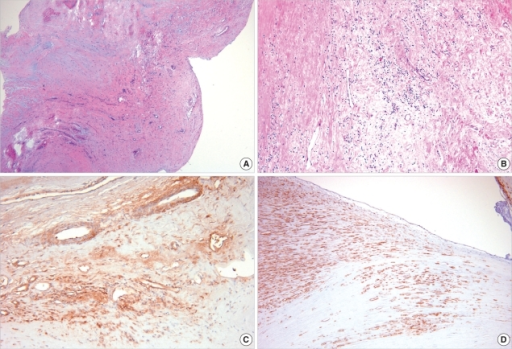 Rheumatic Heart Disease