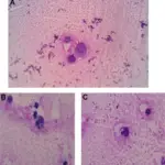 Rheumatoid Arthritis