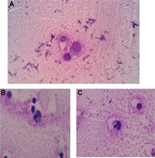 Rheumatoid Arthritis