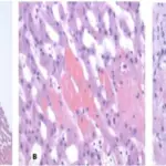 Right-Sided Heart Failure