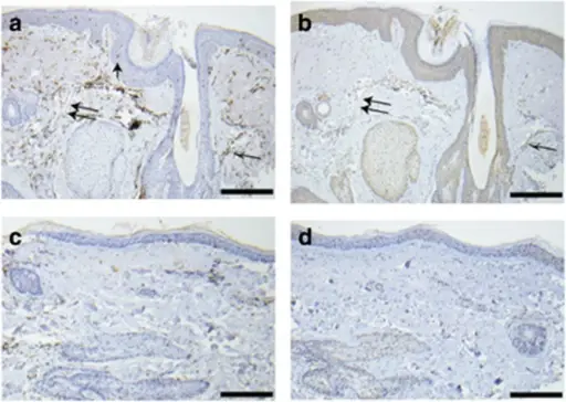 Rosacea