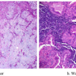 SALIVARY GLAND PATHOLOGY