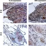 Sarcoidosis