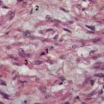 Sarcoma of the Bladder